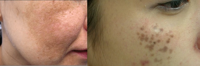 Phân biệt nám và bớt hori