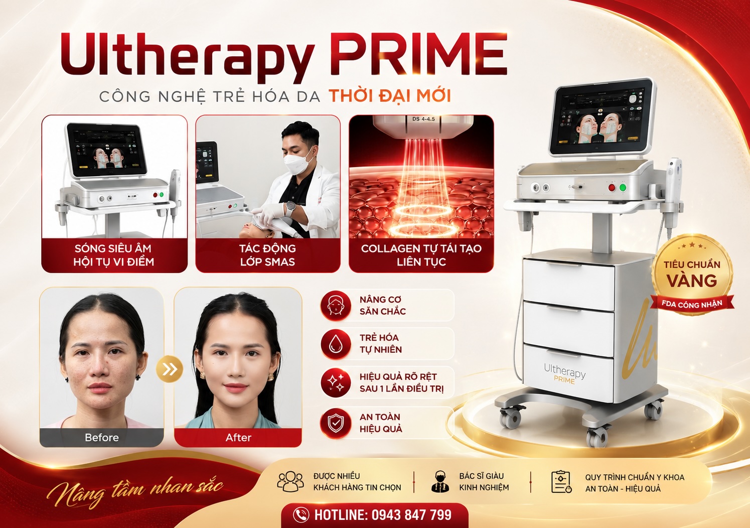 Phương pháp ultherapy