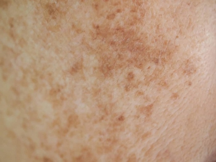 Cách trị nám da bụng sau sinh