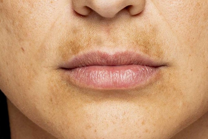 Có bầu bị nám quanh miệng