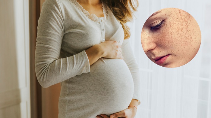 Khi mang bầu bị nám da